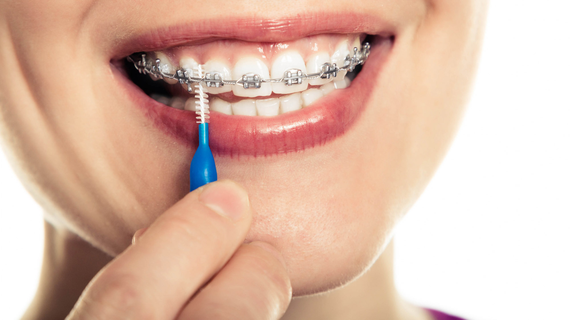 Зубные ершики в ортодонтии: эффективная чистка или дань моде?